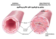 بیماری ریه پاپ‌کورن: علل، علائم و پیشگیری | ریه پاپ‌کورنی چیست؟