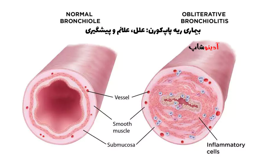بیماری ریه پاپ‌کورن: علل، علائم و پیشگیری | ریه پاپ‌کورنی چیست؟