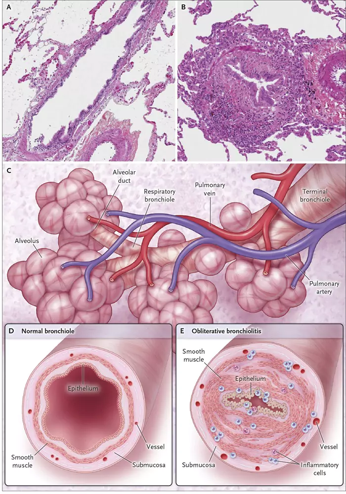 بیماری ریه پاپ‌کورن: علل، علائم و پیشگیری | ریه پاپ‌کورنی چیست؟