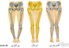 تحقیق در مورد زانوی ضربدری