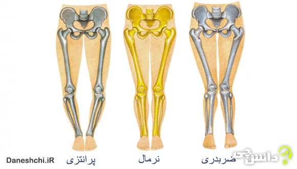تحقیق در مورد زانوی ضربدری