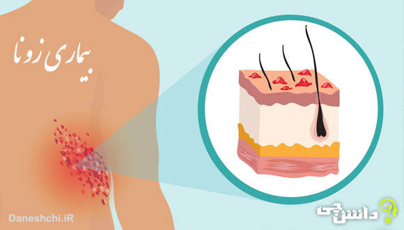 بیماری زونا