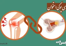 تحقیق در مورد پوکی استخوان، علائم و درمان آن