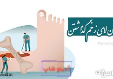 استخوان لای زخم گذاشتن