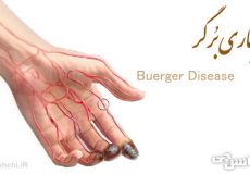 بیماری برگر