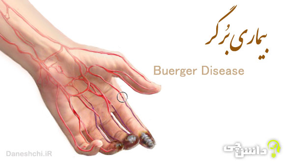 بیماری برگر