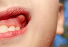 بهترین درمان برای عفونت دندان چیست ؟