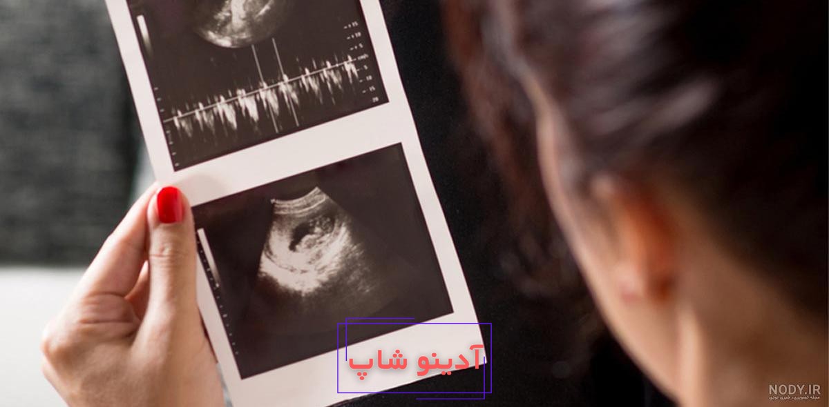 اشتباه سونوگرافی در تعیین جنسیت دختر چقدر است؟ | راهنمای کامل و نکات کاربردی