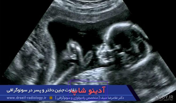 تشخیص جنسیت جنین از روی عکس و فیلم