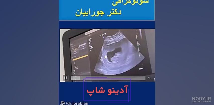 تصاویر سونوگرافی در سه ماهه ی دوم بارداری - هفته چهاردهم تا هجدهم -  سونوگرافی صدرا