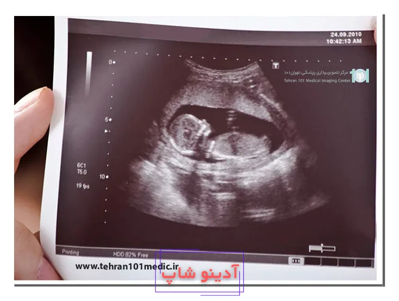 عکس جنین پسر در سونوگرافی - دکتر فاطمه نعمت اللهی - متخصص زنان و زایمان