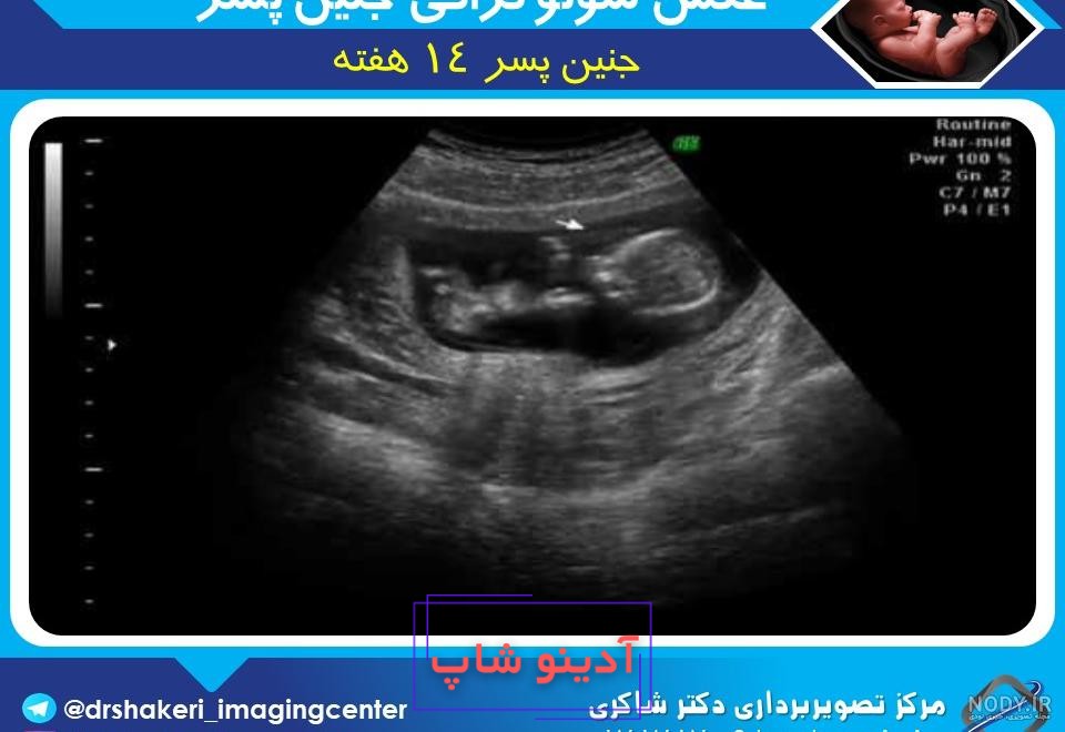 عکس سونوگرافی جنین پسر برای پروفایل