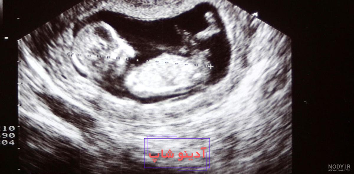 عکس سونوگرافی جنین پسر - مرکز تصویربرداری دکتر شاکری