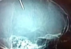 تعبیر خواب میخ در سر + برای زن متاهل و باردار و دختر مجرد و از دید مولف