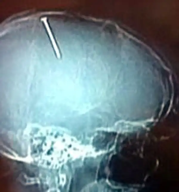 تعبیر خواب میخ در سر + برای زن متاهل و باردار و دختر مجرد و از دید مولف