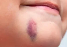 تعبیر خواب صورت زخمی و کبود + برای زن متاهل و باردار و دختر مجرد و از دید مولف