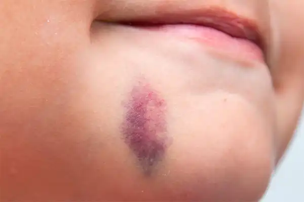 تعبیر خواب صورت زخمی و کبود + برای زن متاهل و باردار و دختر مجرد و از دید مولف