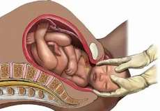 تعبیر خواب زایمان طبیعی ابن سیرین + برای زن متاهل و باردار و دختر مجرد و از دید مولف